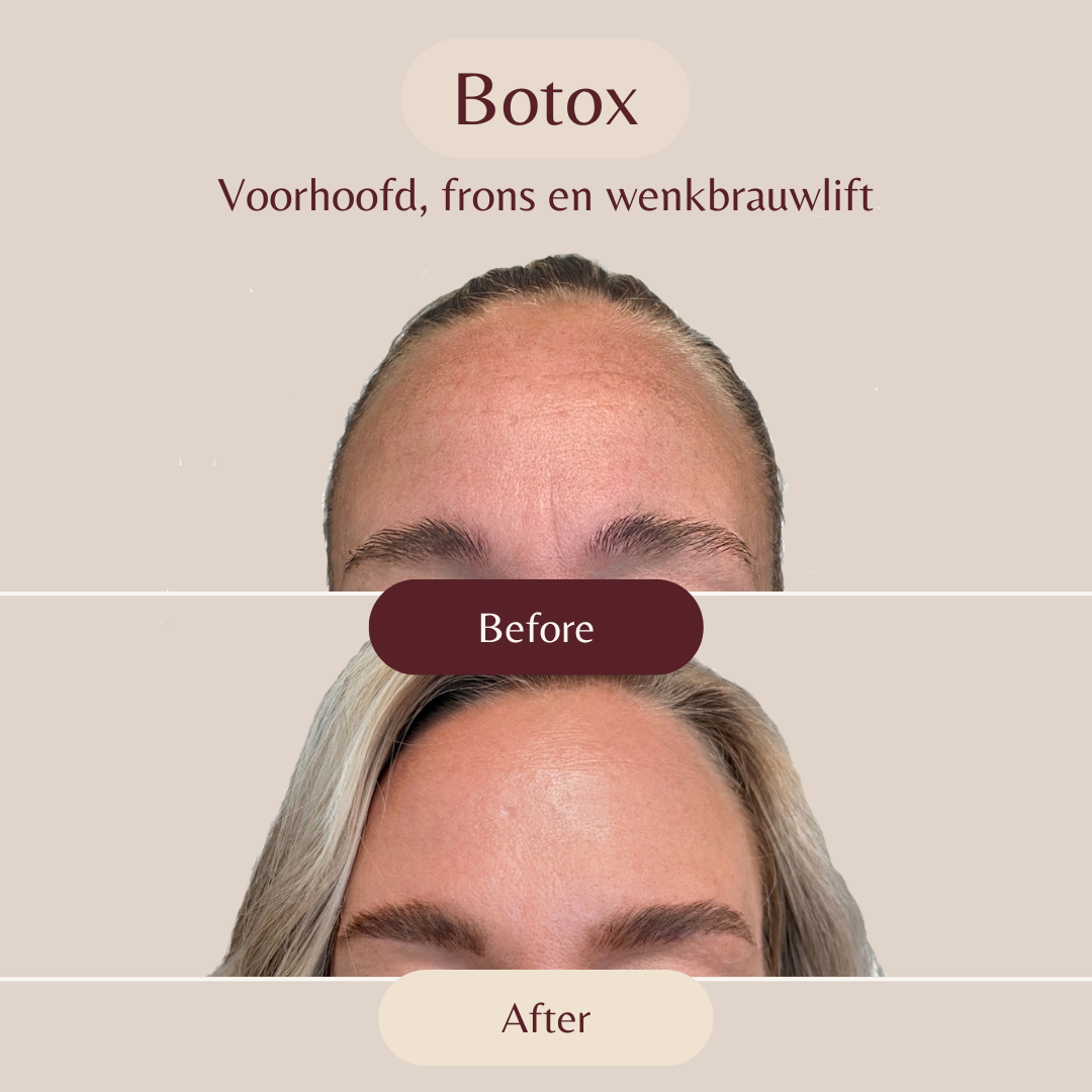 Voor- en na-resultaat fillerbehandeling