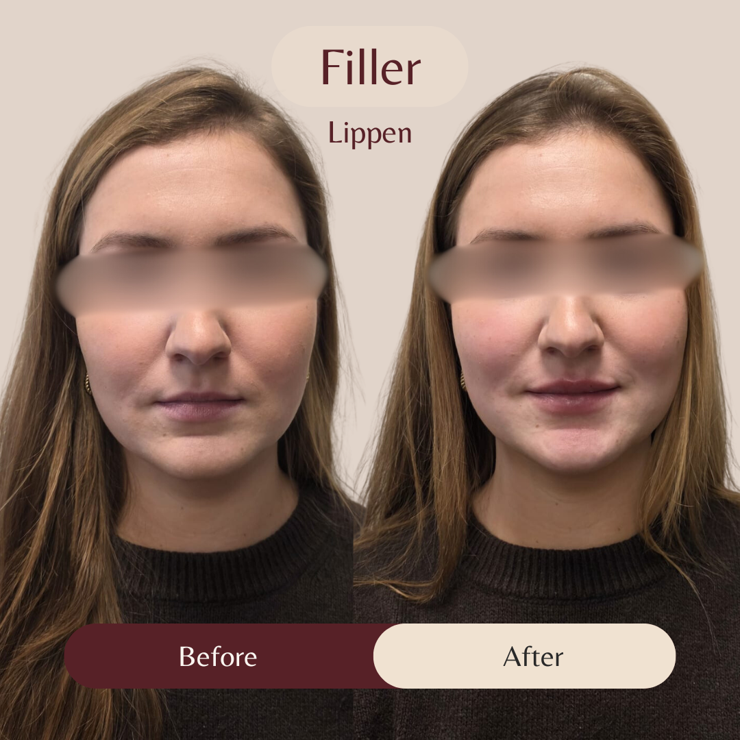 Voor- en na-resultaat cosmetische behandeling